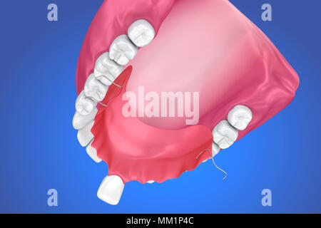 Einzelne fehlende Zahn - herausnehmbare Teilprothese. 3D-Darstellung Stockfoto