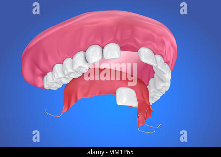Einzelne fehlende Zahn - herausnehmbare Teilprothese. 3D-Darstellung Stockfoto