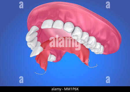 Einzelne fehlende Zahn - herausnehmbare Teilprothese. 3D-Darstellung Stockfoto