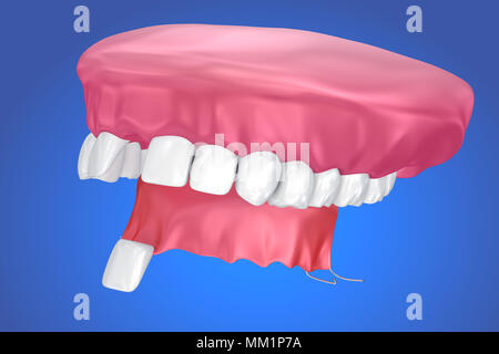 Einzelne fehlende Zahn - herausnehmbare Teilprothese. 3D-Darstellung Stockfoto