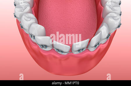 Zähne mit Zahnspangen isoliert auf weiss. Medizinisch genaue 3D-Illustration Stockfoto