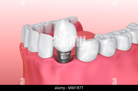 Zahn instalation Prozess Implantat, Medizinisch genaue 3D-Abbildung weiß Stil Stockfoto