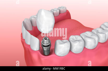 Zahn instalation Prozess Implantat, Medizinisch genaue 3D-Abbildung weiß Stil Stockfoto