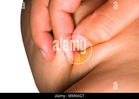 Arzt behandelt Prellung (kontusion) am Bein. Geschlossen Stockfoto