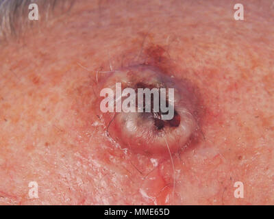 SQUAMOUS ZELLE KREBSGESCHWÜR Stockfoto