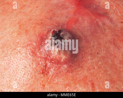 SQUAMOUS ZELLE KREBSGESCHWÜR Stockfoto