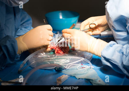 Nierentransplantation Stockfoto