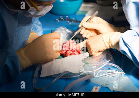 Nierentransplantation Stockfoto