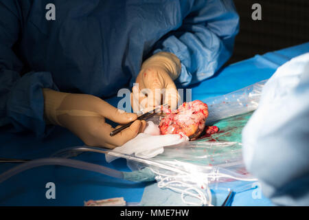 Nierentransplantation Stockfoto