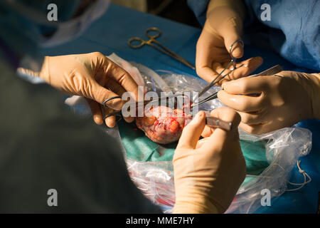 Nierentransplantation Stockfoto