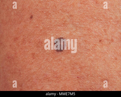 MELANOM Stockfoto
