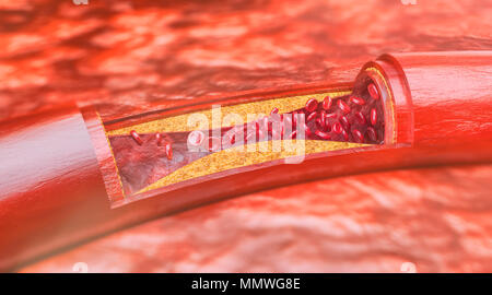 Nahaufnahme einer Arteriosklerose - 3D-Rendering Stockfoto