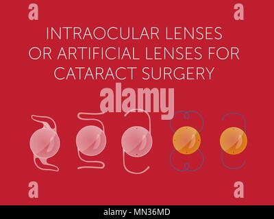 Schematische Arten der künstlichen Linse des Auges auf rotem Hintergrund Stock Vektor
