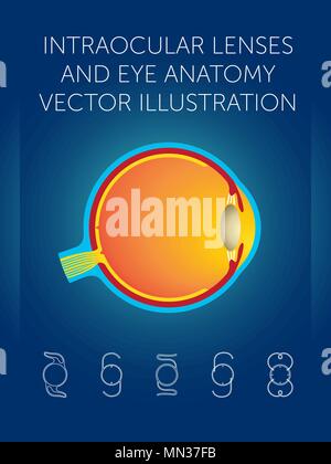 Schematische Darstellung der Struktur des Auges und Arten von Intraokularlinsen auf blauem Hintergrund Stock Vektor