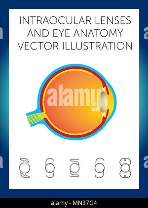 Schematische Darstellung der Struktur des Auges und Arten von Intraokularlinsen auf weißem Hintergrund Stock Vektor