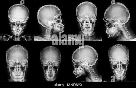 Sammlung Schädel x-ray in grau Ton Stockfoto