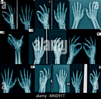 Sammlung x-ray von Hand Stockfoto