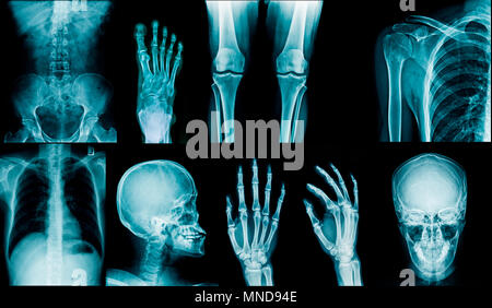 Sammlung x-ray image Schädel, Schulter, Hüfte, Kniegelenk, Skoliose Spinne und kleine gemeinsame in Inhalt Stockfoto
