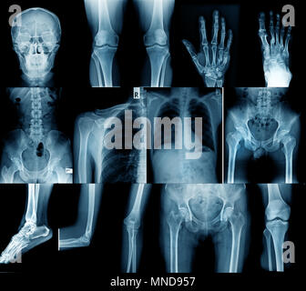 Sammlung x-ray image Schädel, Schulter, Hüfte, Kniegelenk, Skoliose Spinne und kleine gemeinsame in Inhalt Stockfoto