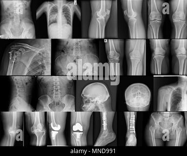 Sammlung x-ray Bild Knie-, Schädel-, Brust-, Rücken-, Becken-, Schulter-, fraktur Bein mit Fixierung Stockfoto