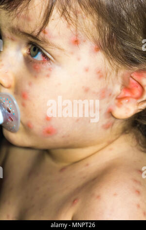 Nahaufnahme von Varicella-zoster Virus oder Windpocken bubble Hautausschlag und Blister auf Babys Gesicht und Körper mit Kruste. Dermatologie Begriff. Stockfoto