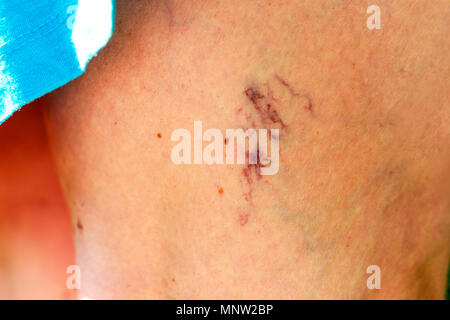 Dermis von Krampfadern an den Beinen betroffen. Close-up. Stockfoto