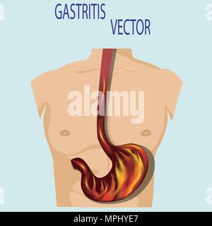 Magenbeschwerden Konzept. Brand im menschlichen Magen, isoliert. Stock Vektor