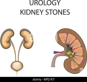 Abbildung: Nierensteine. Urologie und Dialyse Stock Vektor