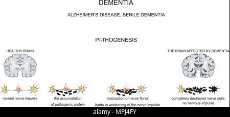 Alzheimer, senile Veränderungen des Gehirns Stock Vektor