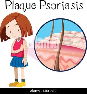 Ein Vektor von Mädchen Plaque-psoriasis Abbildung Stock Vektor