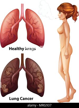 Die menschliche Anatomie Lunge von Raucher Abbildung Stock Vektor