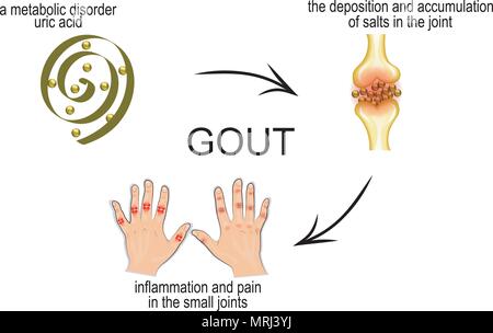 Der Mechanismus der Entwicklung der Gicht. Schmerzen in den Gelenken. Stock Vektor