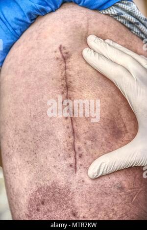 Patienten mit einem frischen lange Narbe nach einer Hüftchirurgie. Makro, menschliches Bein mit blutigen Narbe von hüftgelenk Chirurgie. Stockfoto