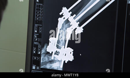 Tierärztin sieht sich der Monitor X-ray Image der Tatze des gebrochenen Hund mit ilizarov der Apparate. X-ray Image der Hund auf dem Monitor in einer Tierklinik. Stockfoto