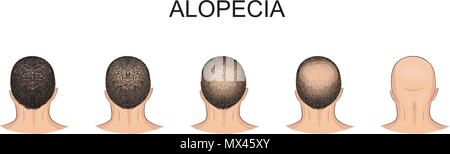Abbildung männlicher Kopf Haarausfall, Alopezie. Stock Vektor