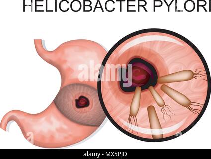 Pathologie des Magens. Anatomie des Magens. Helicobacter pylori Stock Vektor