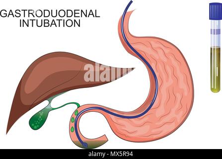 Abbildung: duodenal des Magens. Diagnose von Lebererkrankungen Stock Vektor