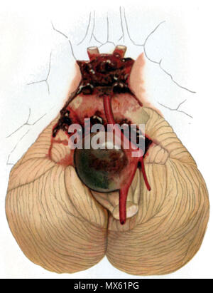 . English: Aneurysma der Arteria basilaris und der arteriae vertebralis Englisch: Aneurysma der Arteria basilaris und die Wirbelsäule Arterien. 10 Dezember 2013, 16:21:57. Professor Dr. O. Bollinger. 120 Cerebelläre Aneurysma Stockfoto