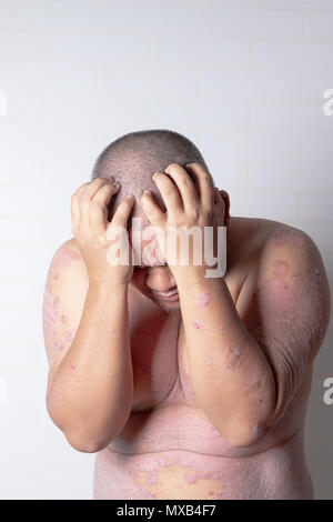 Männer sind mit beiden Händen seinen Kopf zu halten, psoriasis zu belasten. Krankheiten, die durch Störungen des Lymphsystems verursacht. Psoriasis ist eine Hauterkrankung. Stockfoto