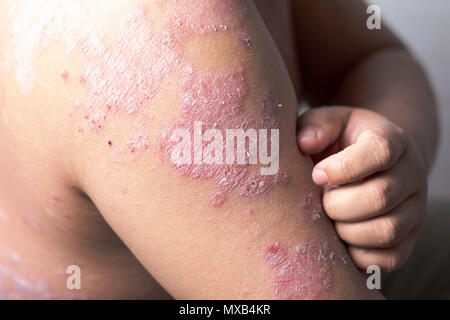 Männer sind mit seinen Händen Kratzer auf den Arm von Magengeschwüren. Krankheiten, die durch Störungen des Lymphsystems verursacht. Psoriasis ist eine Hauterkrankung. Stockfoto