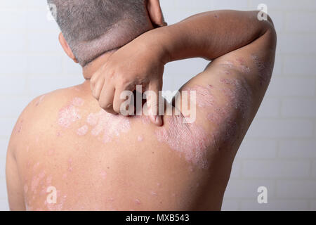 Männer sind mit seinen Händen Kratzer auf der Schulter von Magengeschwüren. Krankheiten, die durch Störungen des Lymphsystems verursacht. Psoriasis ist eine Hauterkrankung. Stockfoto