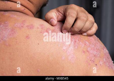 Männer sind mit seinen Händen Kratzer auf der Schulter von Magengeschwüren. Krankheiten, die durch Störungen des Lymphsystems verursacht. Psoriasis ist eine Hauterkrankung. Stockfoto