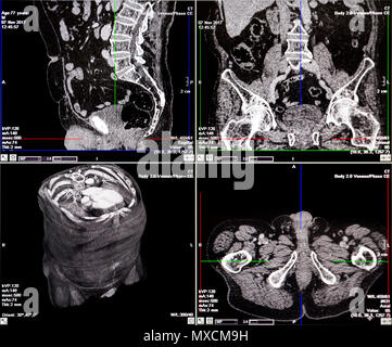 Die Magnetresonanztomographie (MRT) scan-CT Scans der menschlichen Wirbelsäule auf einem Ultraschall Computer überwachen. Stockfoto