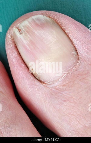 Eines kranken geknackt schmutzigen alten Mann Big Toe Nail Nahaufnahme. Studio Makroaufnahme Stockfoto