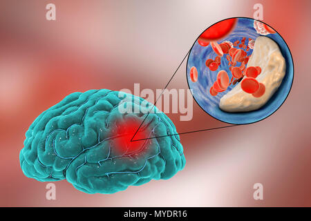 Aufgrund der Atherosklerose Schlaganfall. Abbildung einer arteriellen Blockierung (oben rechts die erweiterte Ansicht), was zu einem Schlaganfall (Apoplexie, CVA). Dieser Strich wird durch einen Aufbau der Plakette, die bei Atherosklerose formen. Diese Blockierung verursacht eine Unterbrechung (Okklusion) der sauerstoffreichem Blut zu versorgen. Dies führt zu einem Schlaganfall, in der das Gehirn durch Hypoxie (Sauerstoffmangel) ist beschädigt. Den grauen Bereich oben rechts zeigt den Bereich des Gehirns durch Mangel an Sauerstoff betroffen. Diese Art des Anschlags ist als atherosklerotischen Anschlag bekannt. Häufige Ursachen sind Bluthochdruck und arterieller Verschlusskrankheit. Stockfoto