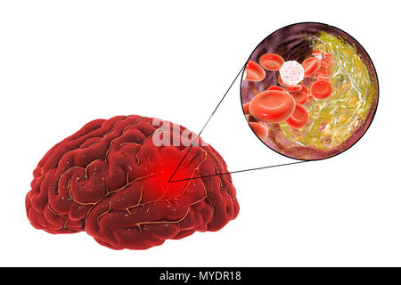 Aufgrund der Atherosklerose Schlaganfall. Abbildung einer arteriellen Blockierung (oben rechts die erweiterte Ansicht), was zu einem Schlaganfall (Apoplexie, CVA). Dieser Strich wird durch einen Aufbau der Plakette, die bei Atherosklerose formen. Diese Blockierung verursacht eine Unterbrechung (Okklusion) der sauerstoffreichem Blut zu versorgen. Dies führt zu einem Schlaganfall, in der das Gehirn durch Hypoxie (Sauerstoffmangel) ist beschädigt. Den grauen Bereich oben rechts zeigt den Bereich des Gehirns durch Mangel an Sauerstoff betroffen. Diese Art des Anschlags ist als atherosklerotischen Anschlag bekannt. Häufige Ursachen sind Bluthochdruck und arterieller Verschlusskrankheit. Stockfoto