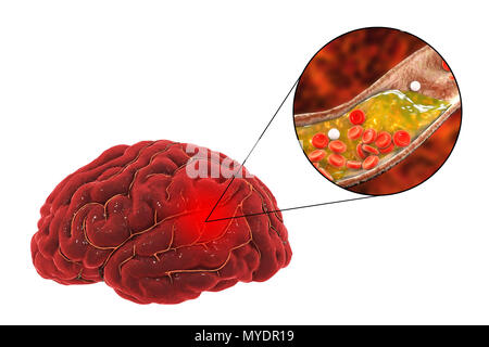 Die Behandlung und Prävention von Schlaganfällen aufgrund der Atherosklerose. Prinzipdarstellung zeigt eine arterielle Blockierung (oben rechts die erweiterte Ansicht), was zu einem Schlaganfall (Apoplexie, CVA). Dieser Strich wird durch einen Aufbau der Plakette, die bei Atherosklerose formen. Diese Blockierung verursacht eine Unterbrechung (Okklusion) der sauerstoffreichem Blut zu versorgen. Dies führt zu einem Schlaganfall, in der das Gehirn durch Hypoxie (Sauerstoffmangel) ist beschädigt. Den grauen Bereich oben rechts zeigt den Bereich des Gehirns durch Mangel an Sauerstoff betroffen. Diese Art des Anschlags ist als atherosklerotischen Anschlag bekannt. Häufige Ursachen sind Stockfoto