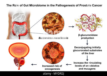 Mikrobiom Darm- und Prostatakrebs. Konzeptionelle Abbildung: Der Verband der Bacteroides massiliensis Bakterien im Dickdarm mit Prostatakrebs Entwicklung. Stockfoto