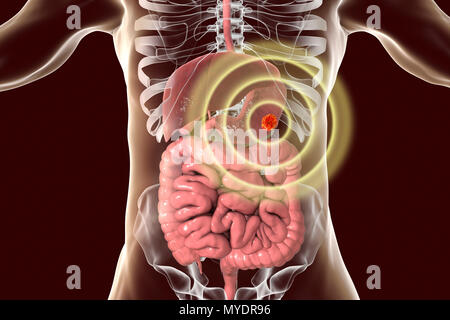 Menschlichen Magen Krebs, konzeptionelle Computer Abbildung. Stockfoto