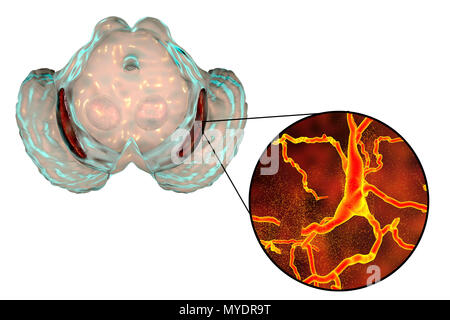 Substantia nigra. Computer zeigt eine Degeneration der Substantia nigra und dopaminergen Neuronen in der Parkinson'schen Krankheit. Die substantia nigra spielt eine wichtige Rolle bei der Belohnung, Sucht, und Bewegung. Degeneration dieser Struktur ist typisch für die Parkinson-krankheit. Stockfoto